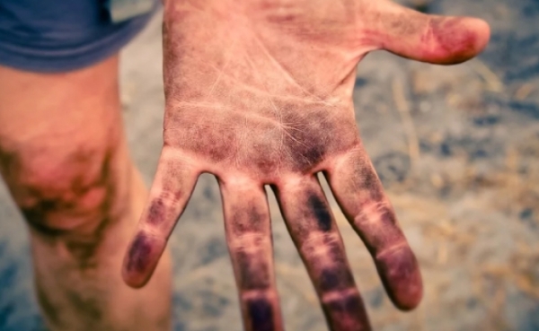 Amprentele se vindeca?