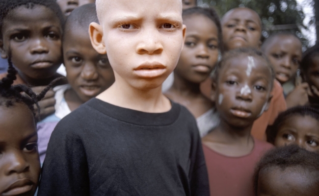Persoanele albinoase din Africa vanate?